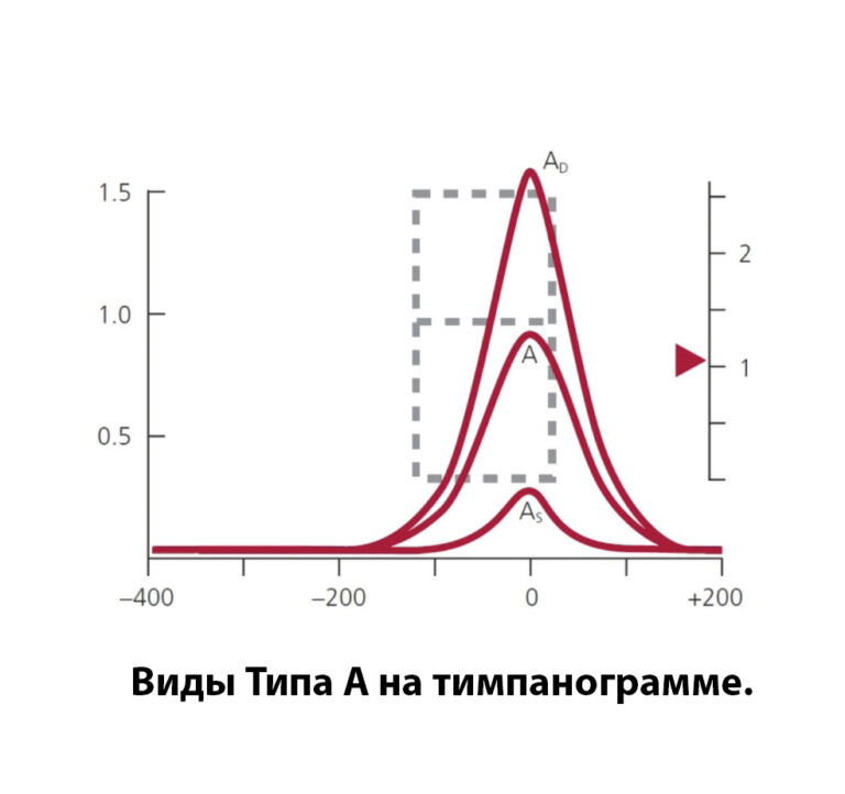 Типы тимпанограмм. Тимпанограмма Тип as. Тимпанометрия типы тимпанограмм. Тимпанометрия графики. Типы тимпанометрических кривых.